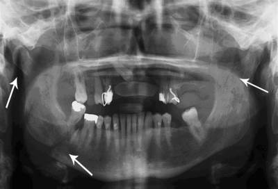 المنظار لإصلاح كسور مفصل الفك وأمراض الغدد اللعابية