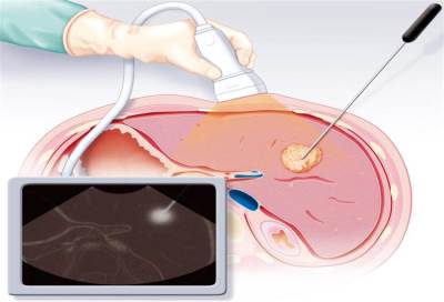 أخيرا .. بجث ياباني يتمكن من علاج تليف الكبد