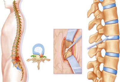 آلام تضيّق العمود الفقري .. الأسباب والعلاج