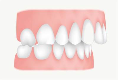«العضة المفتوحة» .. أسبابها وطرق علاجها