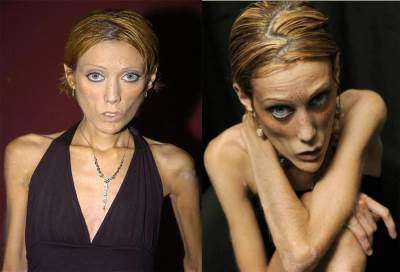 البوليميا والانوركسيا .. أحدث وأشهر أمراض العصر