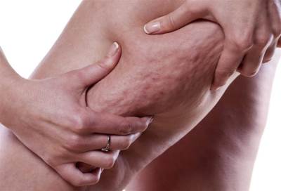 الوخز بالإبر .. طريق سهل للتخلص من السيلوليت