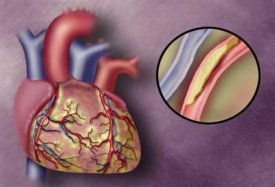 نظام بالليزر للكشف عن طبقات الدهون في الشرايين