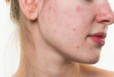 نصائح للتخفيف من حدة حبّ الشباب خلال فصل الصيف