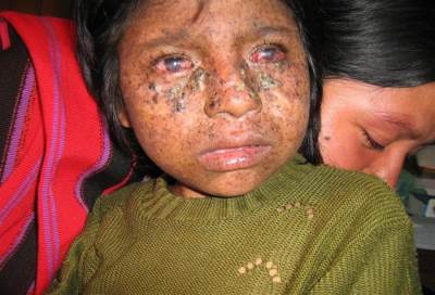 التقرح الجلدي الاصطباغي .. مرض خطير يقتل من يتعرض للنور