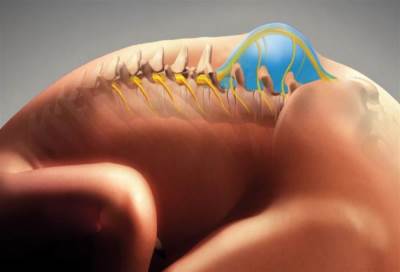 الدليل الطبي الكامل لأسباب وعلاج مرض الصلب المشقوق