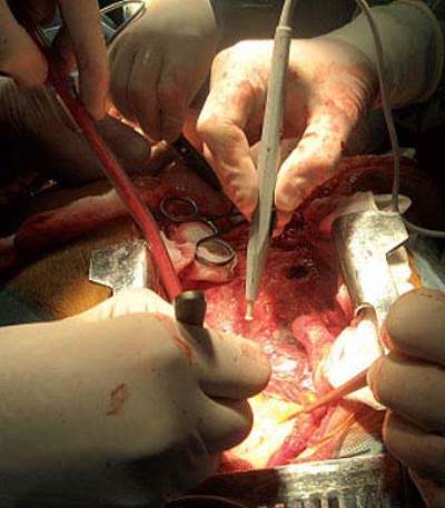 زراعة الأعضاء خارج الحدود  .. مكامن الخطر وطرق الوقاية