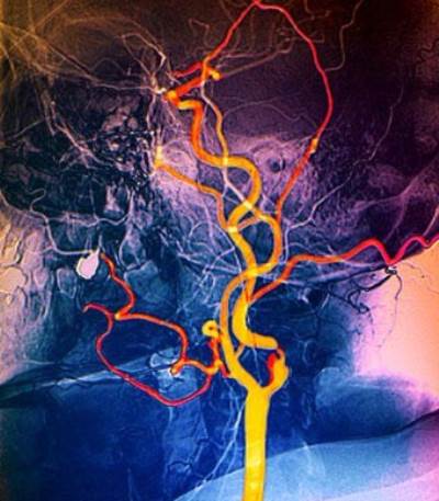 تضيق الشرايين .. العلاج الطبي الأمثل أم العمليات الجراحية؟