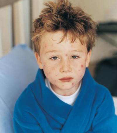 أشعة الشمـس تمنع انتشار الجديري المائي