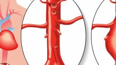الدليل الكامل لتشخيص وعلاج تمدد الشريان الأورطى الباطني