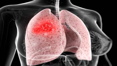 تطوير اختبار يميز بين أنواع سرطان الرئة .. عن طريق النفس