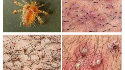 قمل العانة .. أسباب الإصابة وطرق العلاج