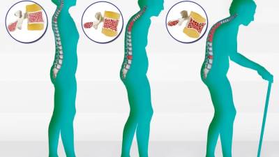 جدل حول أهمية تناول أدوية «البيفوسفونيت» لفترة طويلة في علاج هشاشة العظام