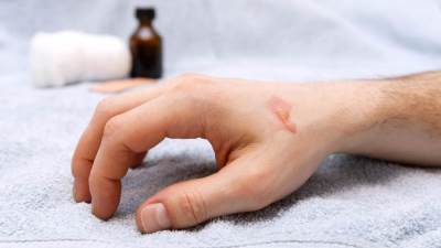  الحروق .. ما هي وسائل إسعافاتها الأولية؟