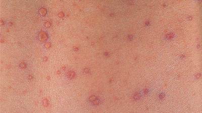 قصة مريض بطفح جلدي .. حير الأطباء