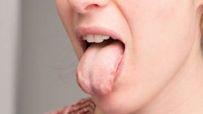 إخصائي باطنه : تغيير لون اللسان مؤشر لمشكلات صحية