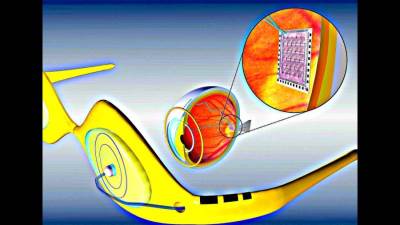 ثورة طبية : عين صناعية للمصابين بالتهاب الشبكية الصباغي