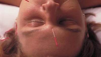 الإبر الصينية .. كيف تعالج الألم المزمن؟