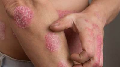 الباحثون يكتشفون علاقة بين داء الصدفية ومرض السكري