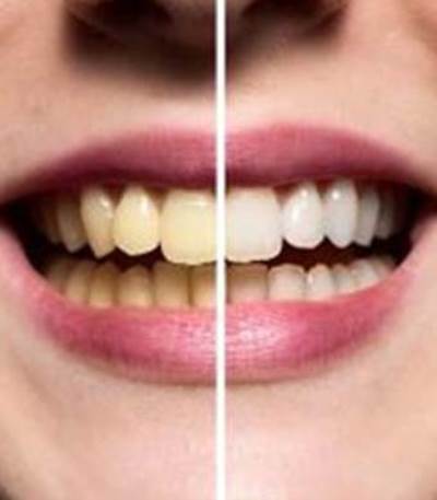 طبيب أسنان : لون حشوات الأسنان والجسور لا تتغير بعملية التبييض