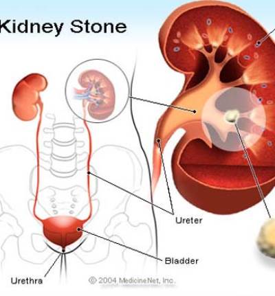 نمط الحياة .. ما علاقتها بحصى الكلى؟