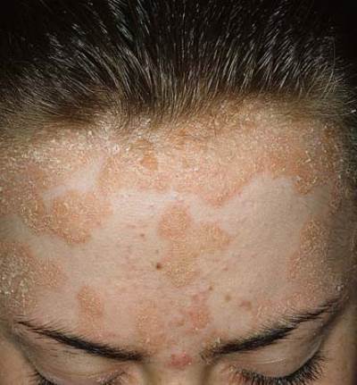 تعرف على أسباب الإصابة بالصدفية وطرق علاجها