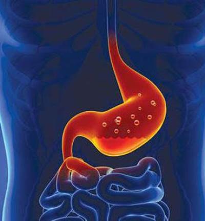 حرقة الفؤاد .. كيف نقلل من أثارها المزعجة؟