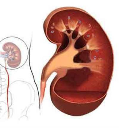 الفشل الكلوي عند المراهقين ..  ما مسبباته؟