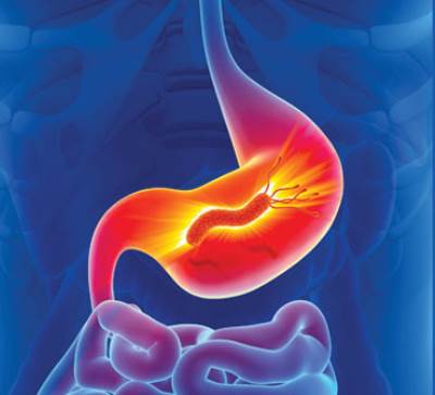 مركب في الزيوت النباتية .. يدمر الجرثومة الحلزونية المسببة لقرحة وسرطان المعدة