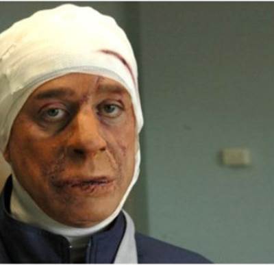 صورة شريف منير على فيسبوك التي أرعبت جمهوره ماذا حلّ بوجهه؟