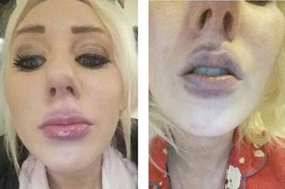 أرادت شفاه "كايلي جينر" .. فإستخدمت طريقة منزيلة والنتيجة كارثية