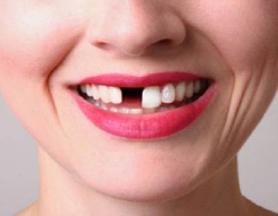 فقدان الأسنان .. ما علاقتها بمخاطر أمراض القلب؟