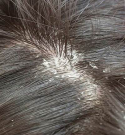  اقضي على قشرة الشعر نهائياً وببساطة