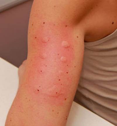 علامات تخبر عن حساسية جسمك للجلوتين/القمح