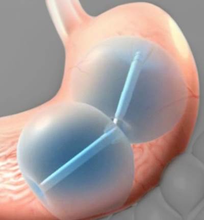 جهاز بالون مزدوج .. لتقليص معدة المصابين بالسمنة