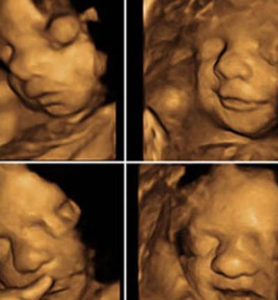  تصوير الجنين للذكرى .. بدعة لها مخاطرها