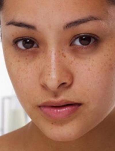  الهالات السوداء .. العلاجات المنزلية والإجراءات التجميلية