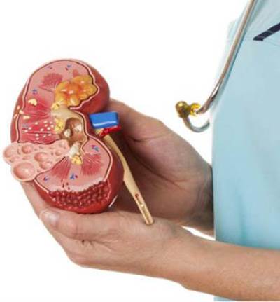 8 نصائح من أجل كليتين سليمتين