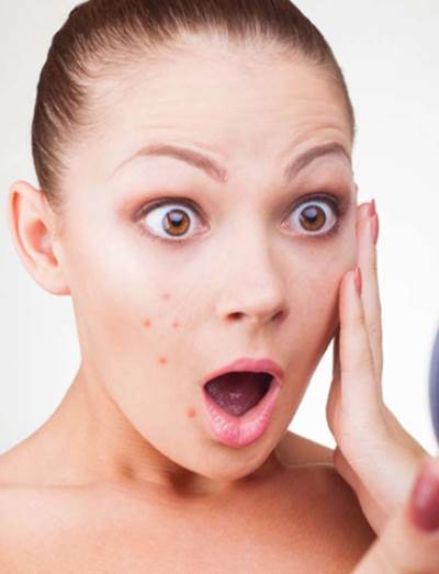 لا تجربى هذه الوصفات المنزلية لعلاج حب الشباب أبدا !