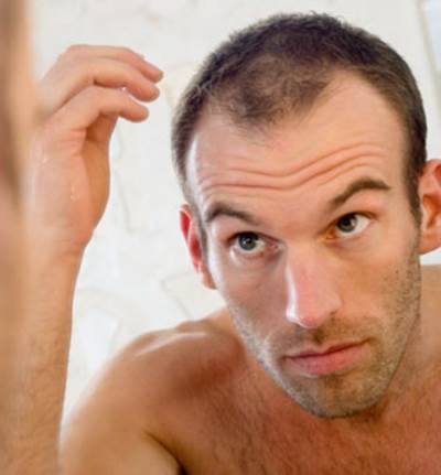 مفاهيم خاطئة شائعة حول صلع الرجال