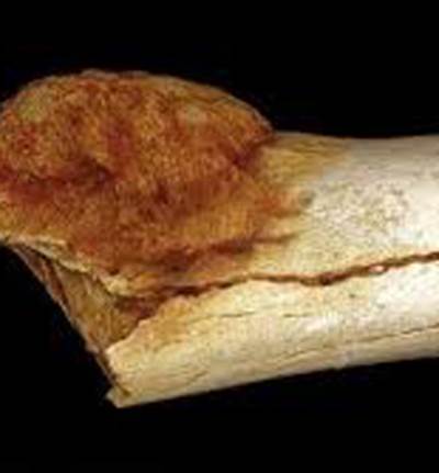  أول إصابة بشرية بالسرطان منذ 1,7 مليون سنة