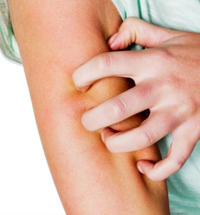 نصيحة "الجمال".. تخلصى من لدغات الحشرات فى الصيف بهذه الطريقة