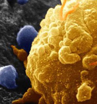 أعراض سرطان المبيض تتشابه مع مشاكل صحية شائعة لدى النساء