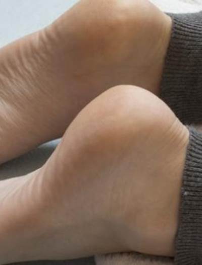 الجليسرين .. لمنع تشقق القدمين هذا الشتاء