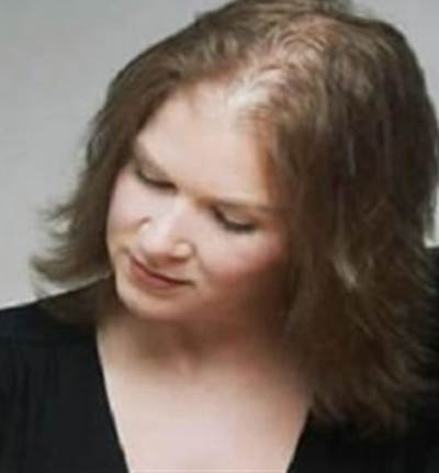 7 أسباب لتطاير وسقوط شعر الجسم 