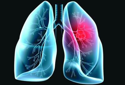 الدهون المشبعة تسبب هذا المرض الخطير