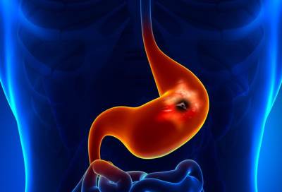 تعرف على أسباب وأعراض قرحة المعدة