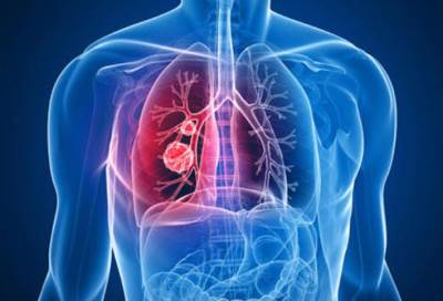 احمي نفسك من سرطان الرئة بهذه الوسائل