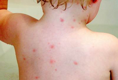 تعرفي علي علاج الجدري المائي
