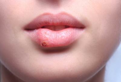 هل يسبب الهربس مرض الزهايمر؟